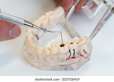 Root Canal Therapy & Treatment..