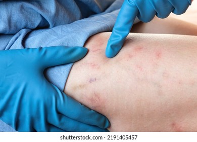 Pregnancy and varicose veins